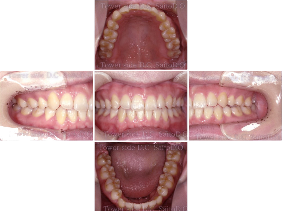 症例（施術後）