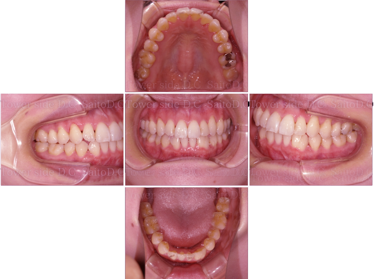 症例（施術後）