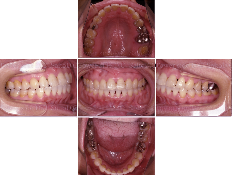 症例（施術後）