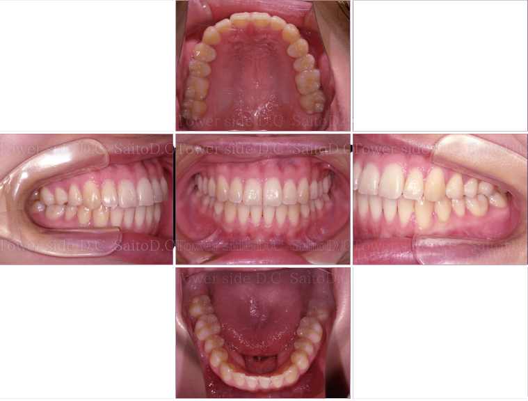 症例（施術後）