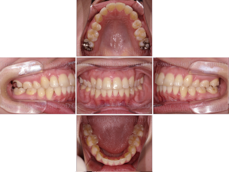 症例（施術後）