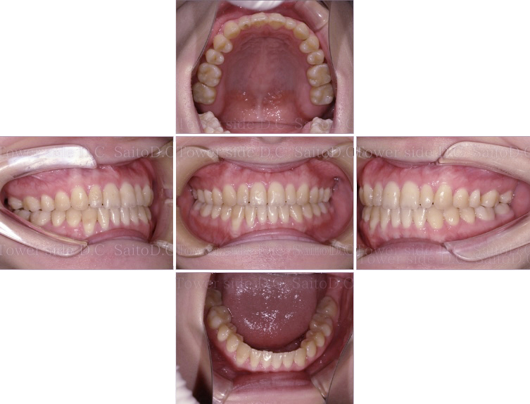 症例（施術後）