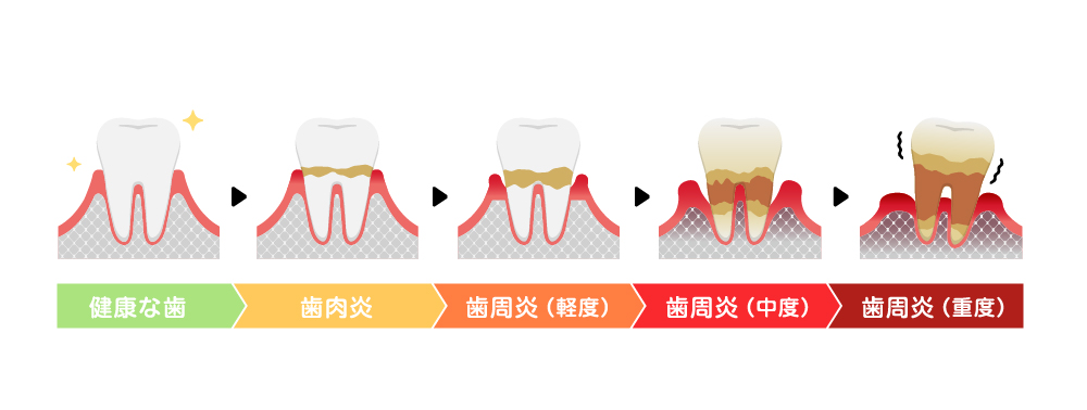 歯周病