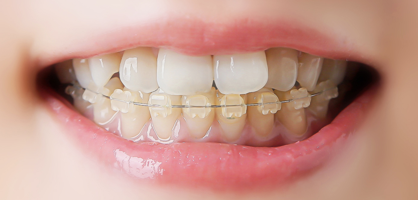 抜歯後の矯正