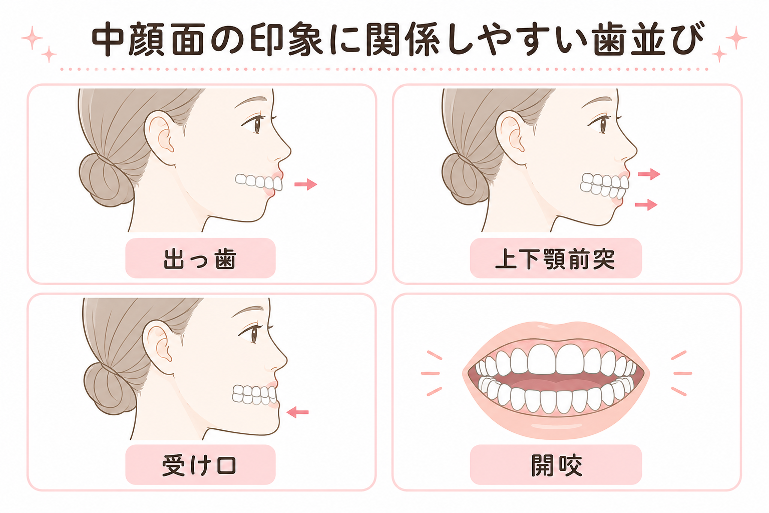 中顔面の印象に関係しやすい歯並び