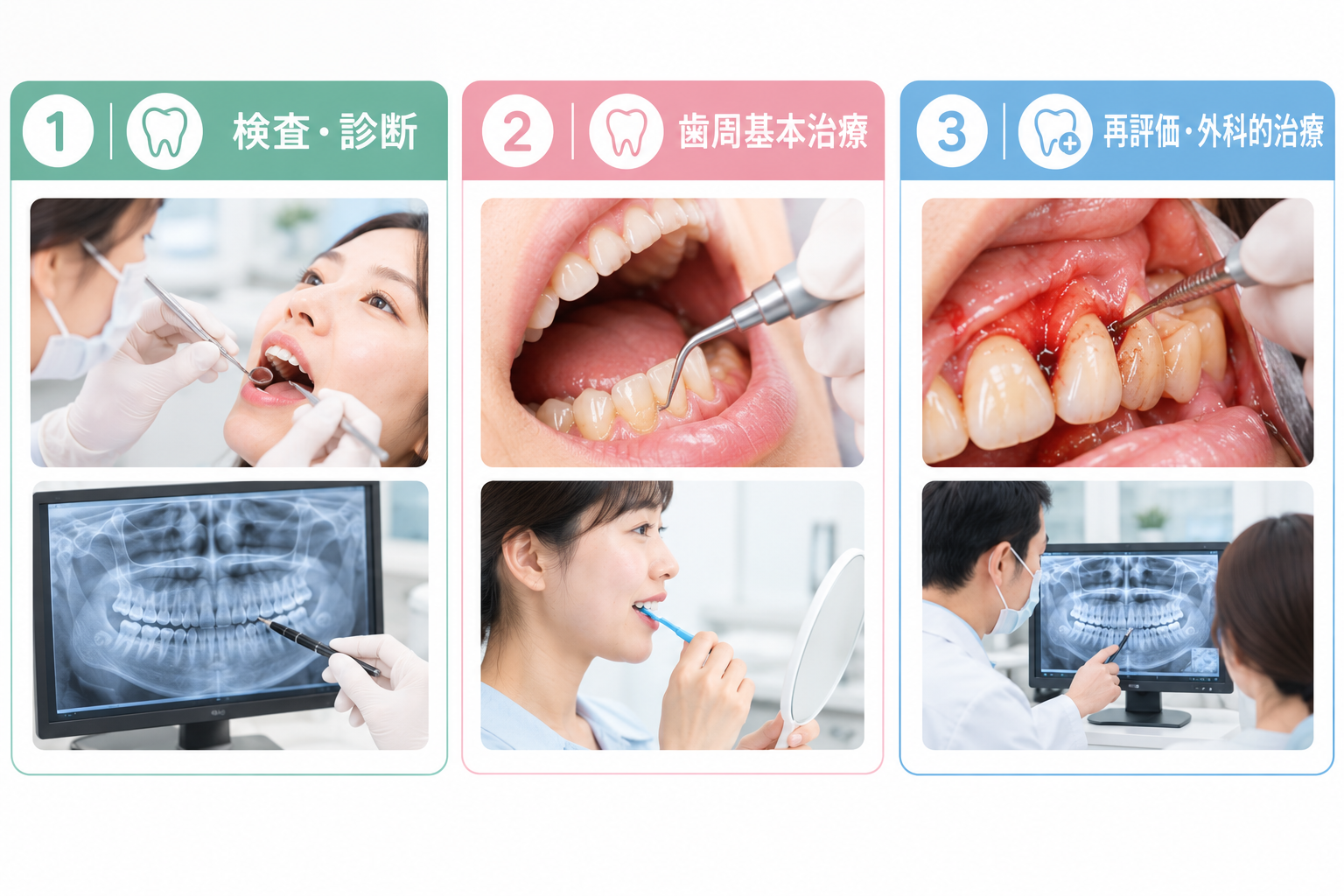 進行した歯周炎の検査と治療